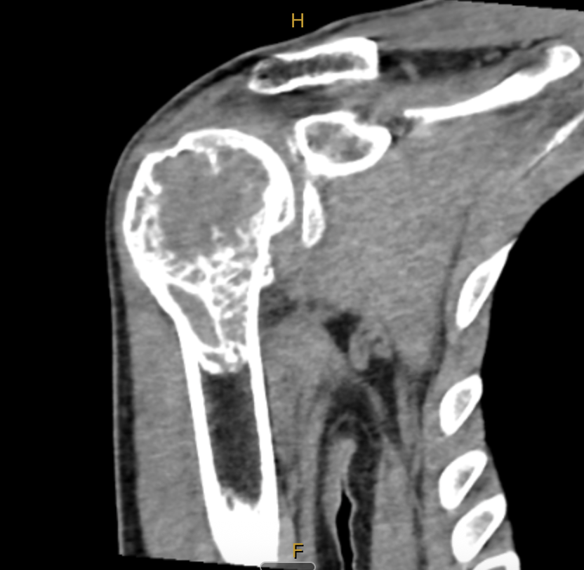MRI scan showing giant cell tumour in the right proximal humerus