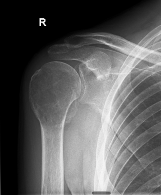 X-ray showing giant cell tumour in the right proximal humerus