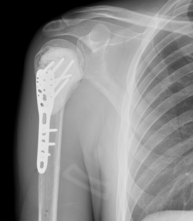 Post-operative X-ray showing plate and cement in the right proximal humerus
